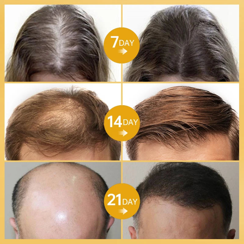 PURC Fast Hair Growth for Men Women Hair Oil Care Ginger Anti Hair Loss Scalp Treatment Grow Serum Products Beauty Health 35ml