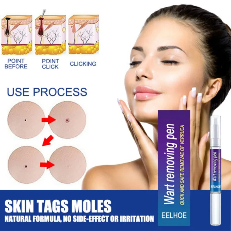 🍀Wart Removal Mole Remedy Liquid Pen Treatment Papillomas Removing Skin Labels Flat Wart Genitals Painless Beauty Herbal Cream