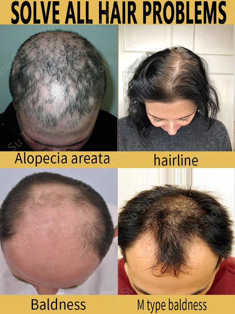 Hair Growth Oil Baldness for men treatment