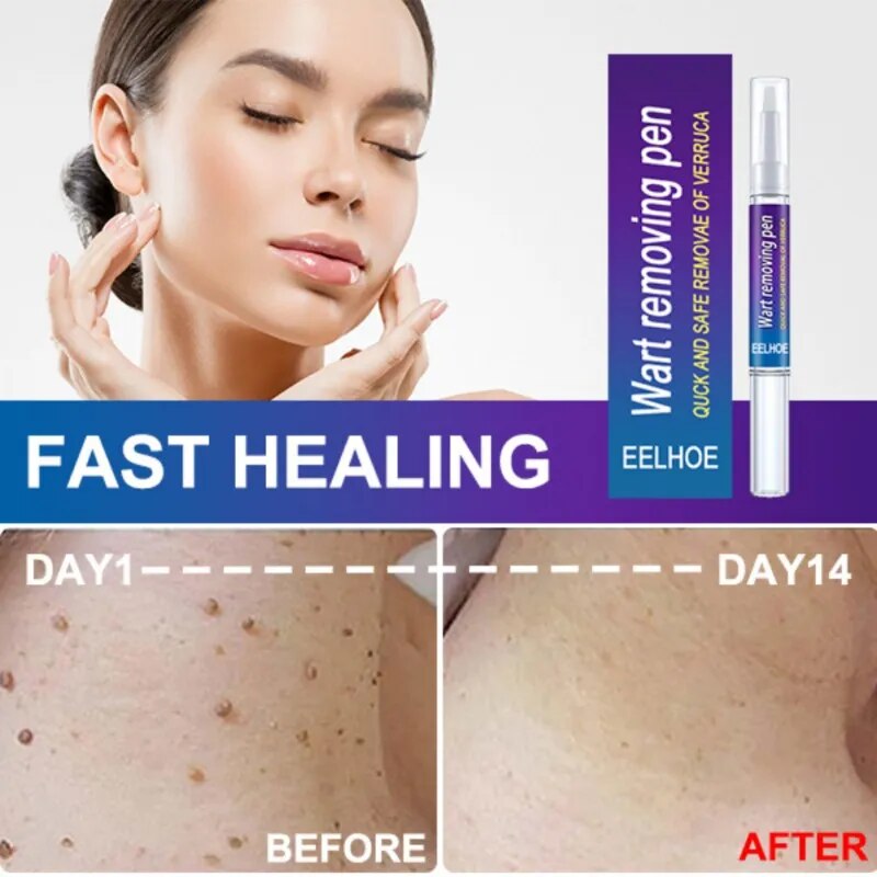 🍀Wart Removal Mole Remedy Liquid Pen Treatment Papillomas Removing Skin Labels Flat Wart Genitals Painless Beauty Herbal Cream